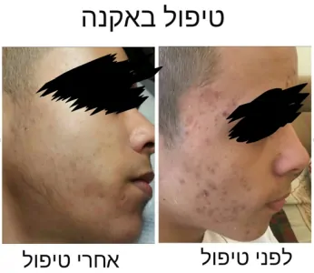 שרה חסון טיפול באקנה