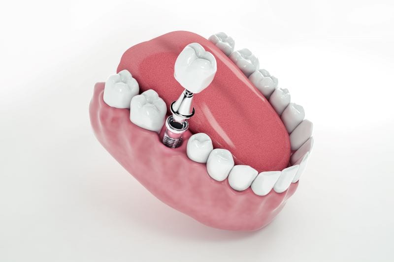 ביי פוסט FREEPIKview-from-false-tooth-implant-fixed-jawbone-3d-3d-illustration